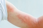 covid-19, covid-19, dermatological symptoms could be a sign for covid 19 infection, Sexually transmitted disease