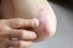 Skin disorders news, Skin disorders health problems, five common skin disorders and their symptoms, Skin disorders