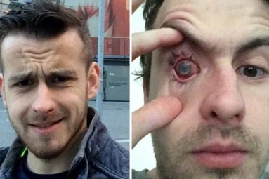 Contact Lens Wearers Beware! Man Goes Blind After Parasites Eat Man's Eye as He Wore Lenses in Shower