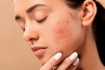 skin, home remedies, 10 ways to get rid of pimples at home, Healthy food