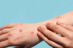 Monkeypox WHO, Monkeypox latest updates, study says that the symptoms of monkeypox are different from earlier, Monkey
