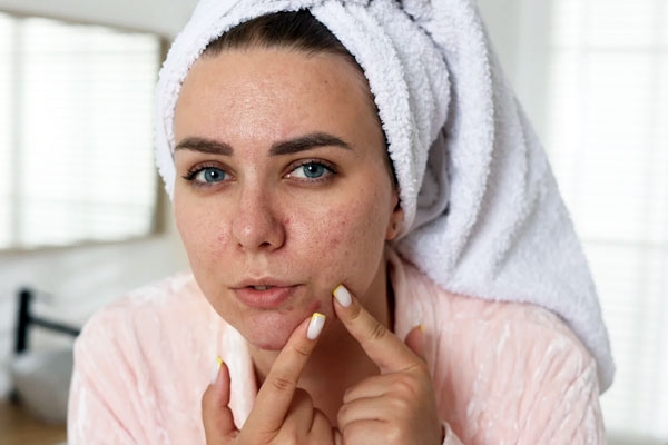 This Drink may help Get Rid of Stubborn Pimples