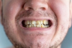 Nicotine stains breaking, Nicotine stains breaking, are nicotine stains on your teeth irreversible, Tobacco
